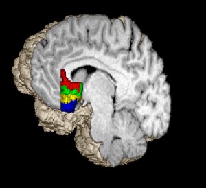 the subgenual prefrontal cortex is in red